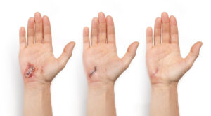 Wound,Healing,Visualization,Of,Hand,With,Laceration,And,Stitches.,Female