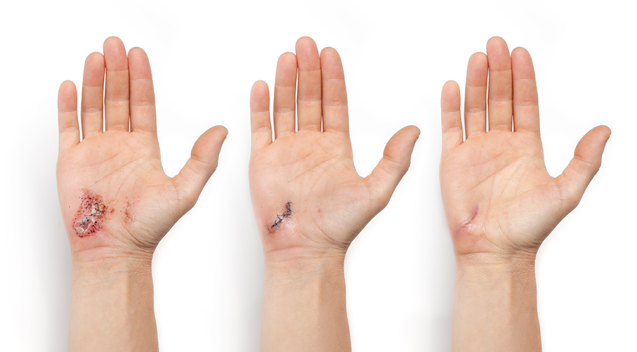 Wound,Healing,Visualization,Of,Hand,With,Laceration,And,Stitches.,Female